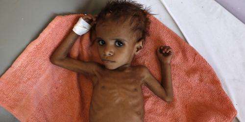 Lille underernæret dreng i Yemen
